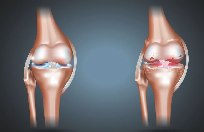 Une image de deux articulations. Une articulation saine et une articulation endommagée