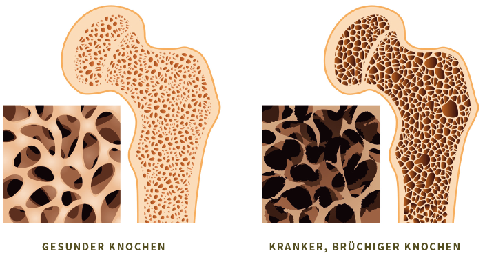 Gesunder und kranker Knochen im Vergleich