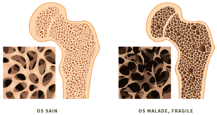 Comparaison d’os sains et malades